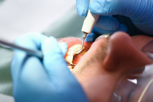 Best Emergency Dental Care for Abscessed Tooth in Pendleton, IN